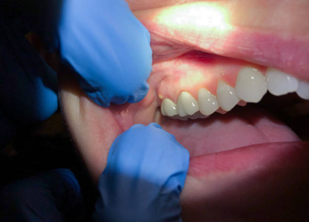 Best Emergency Tooth Extraction  in Deforest, WI